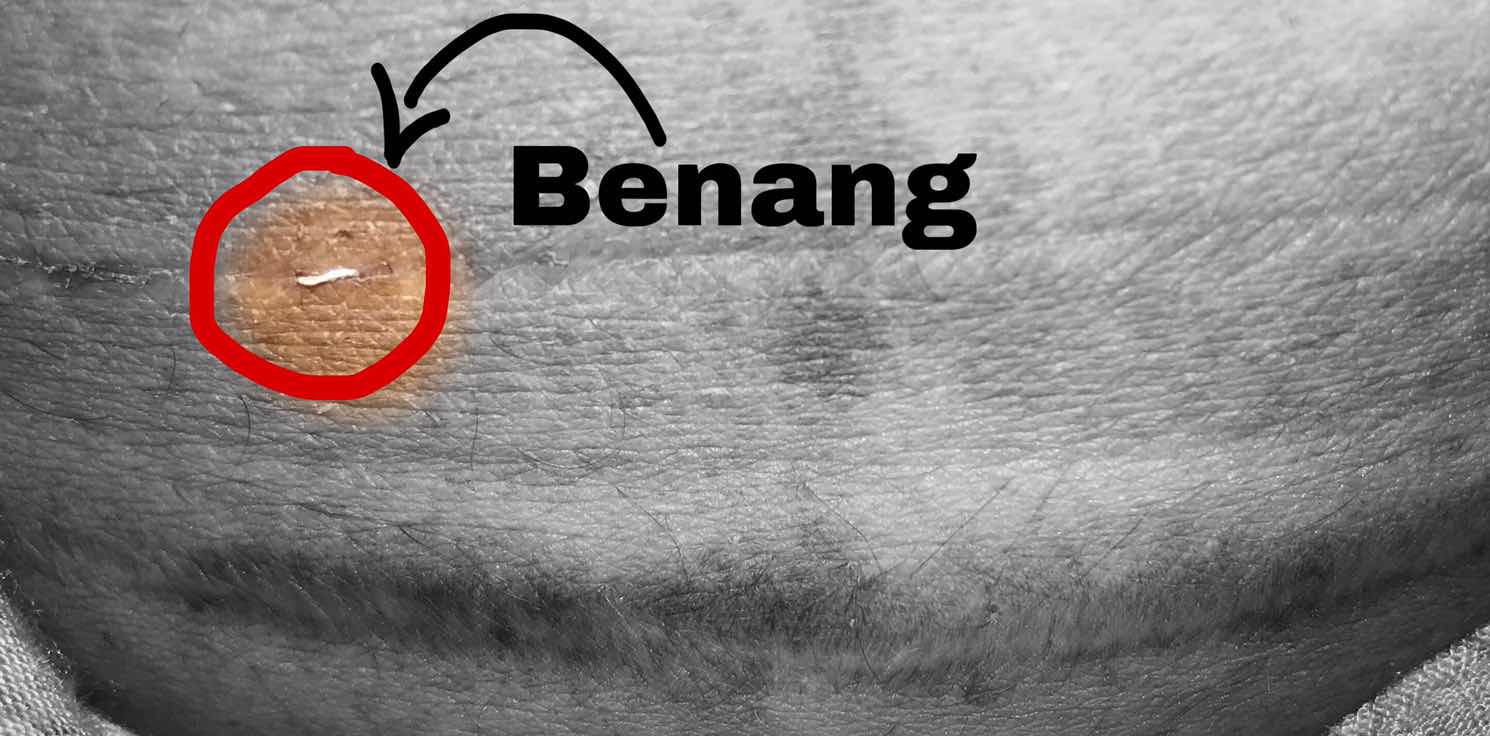 Benang jahitan sesar keluar?