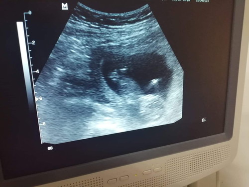 ลูกเราตัวเล็กไปมั้ยค้ะ ขอดูอัลตร้าซาวด์ของแม่ๆช่วง 12w หน่อยค่ะ