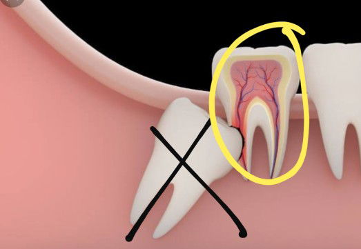 wesdoom teeth part II