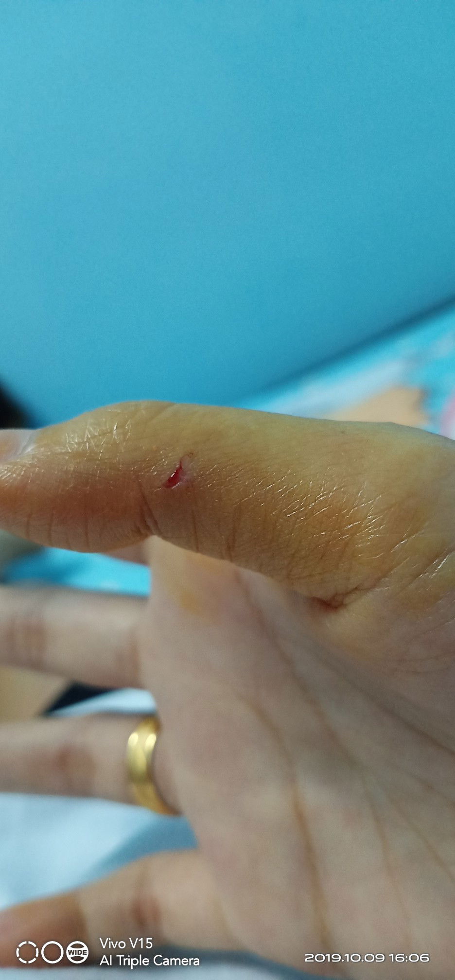 chó cắn nhẹ vậy có sao không.