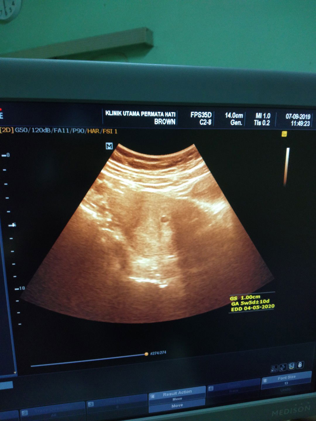 Perbedaan usia kehamilan menurut HPHT dan USG