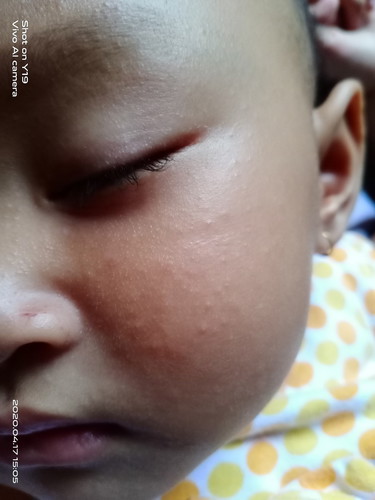wajah baby beruntusan