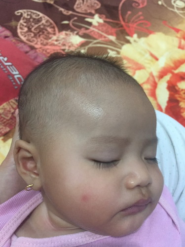 Putih di pipi bayi