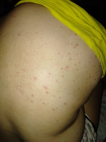 rashes???