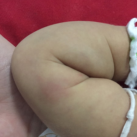 ตุ่มแข็งๆ