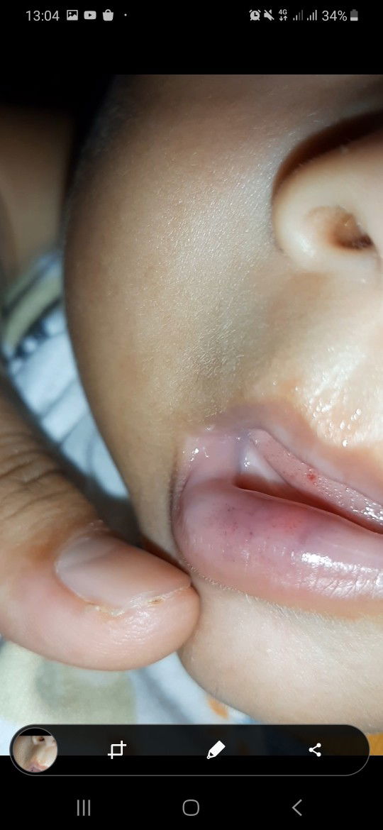 Bayi usia 5 bulan ada bintik2 merah di ujung lidahnya