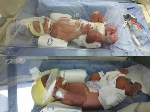 รูปเเรก ของ น้องเเฝด ซันซาน