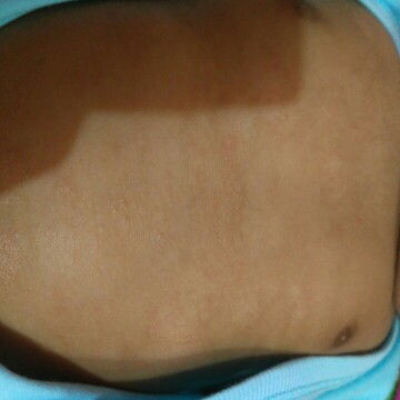 ngilangin bekas gatel gimana ya?