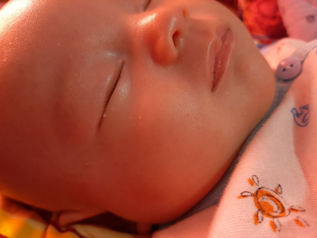 bintik putih sejak lahir.