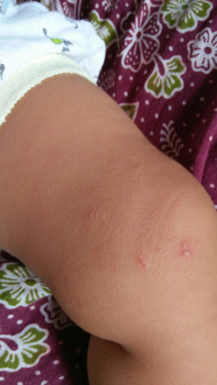 bintik merah bernanah