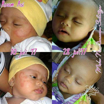 Mengatasi kemerahan pada baby