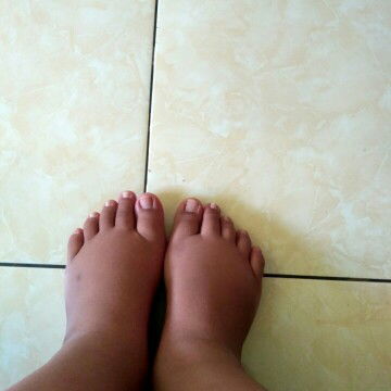 Bengkak Kaki Penyebabx Apa?