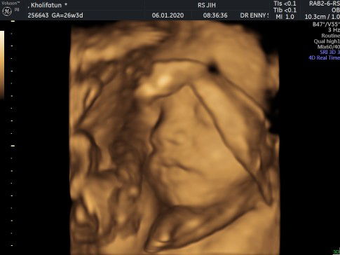 Pengalaman USG 4D usia 26W3D