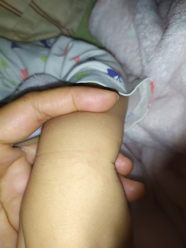 ลูกมีตุ่มขึ้นตามมือ เข่า และท้อง