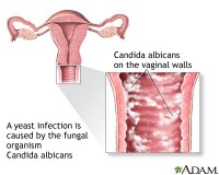 YEAST INFECTION