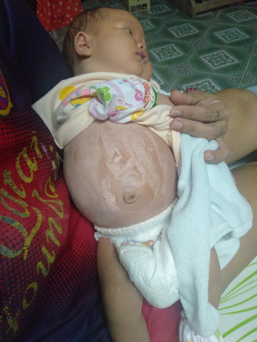 น้องท้องโต