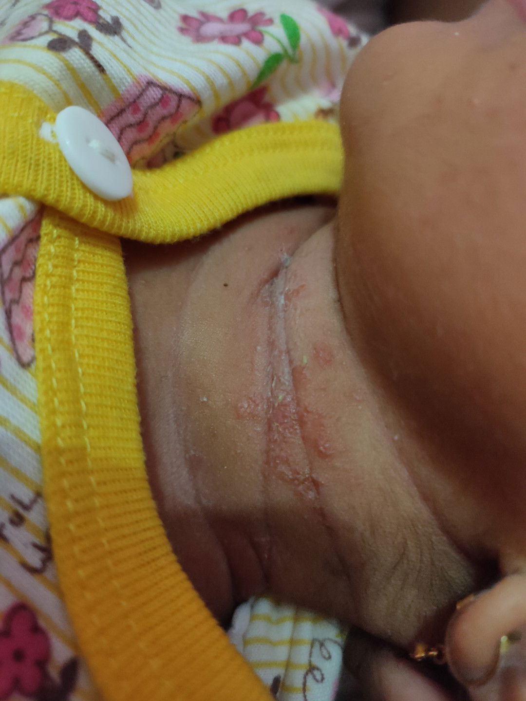 Bun ini obatnya apa?