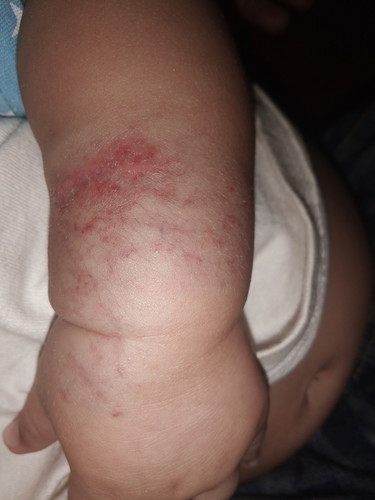 merah pada pergelangan bayi