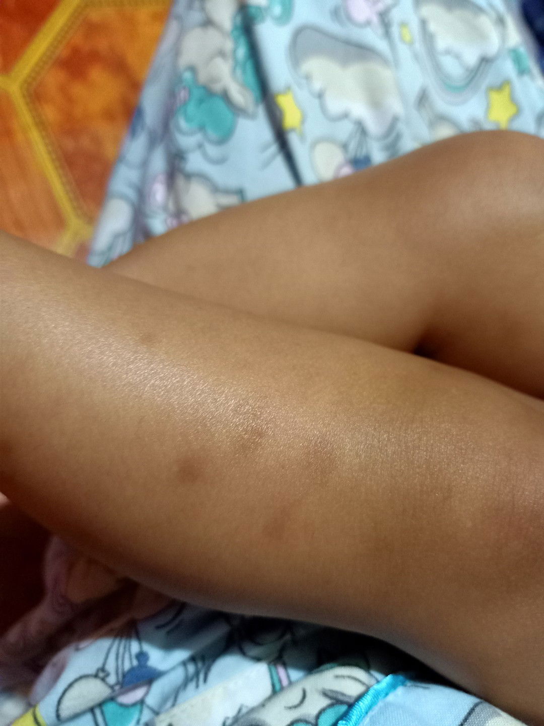 Bekas gigitan nyamuk