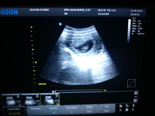 kehamilan resiko tinggi