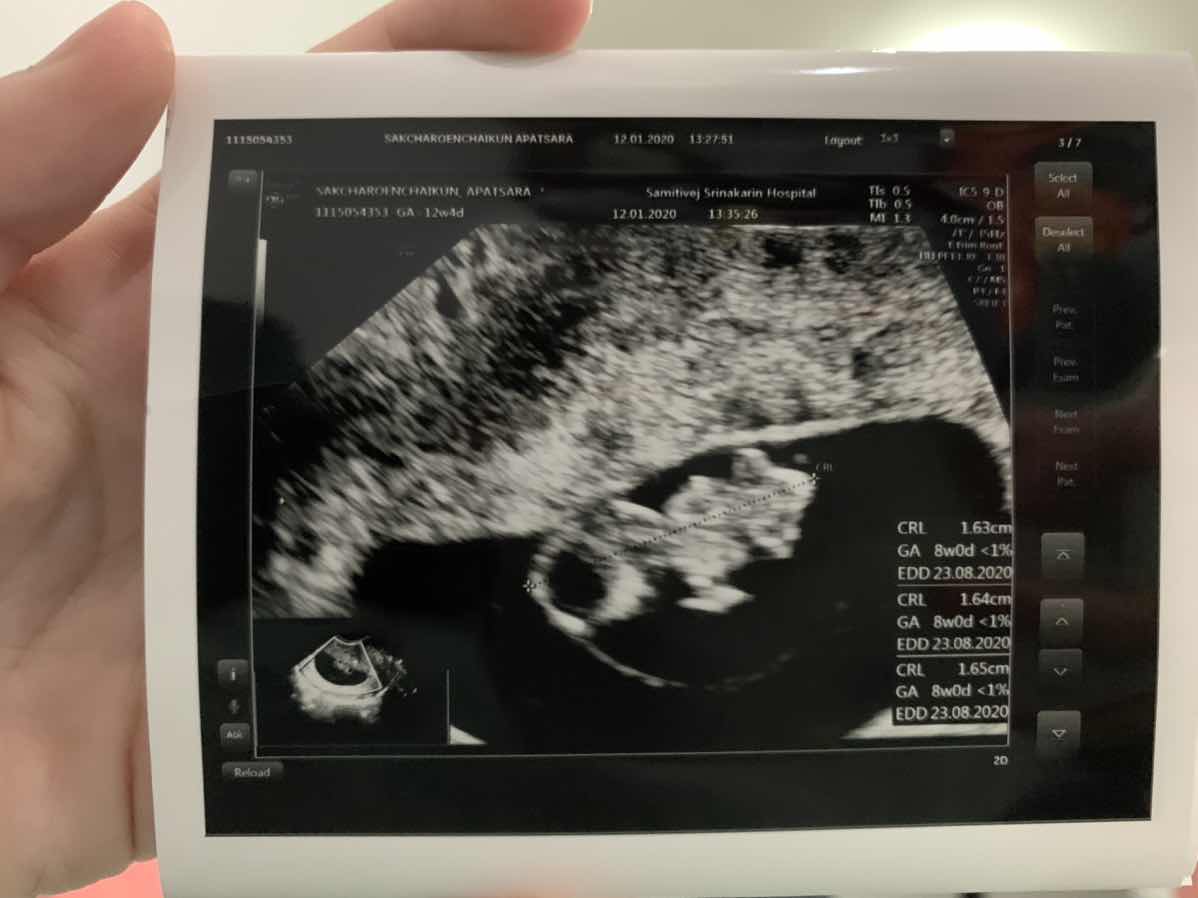 อายุครรภ์ 8 สัปดาห์