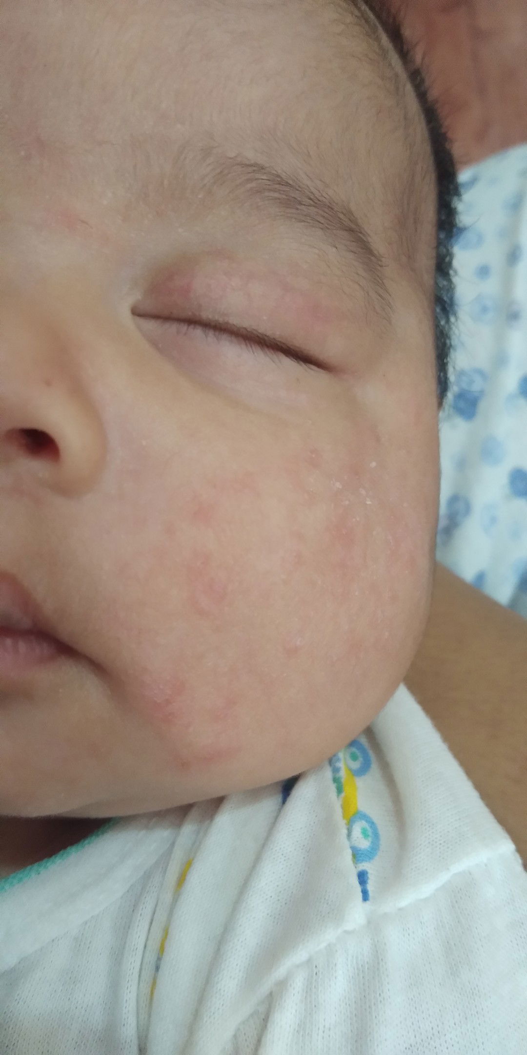 merah dan kering pada muka bayi