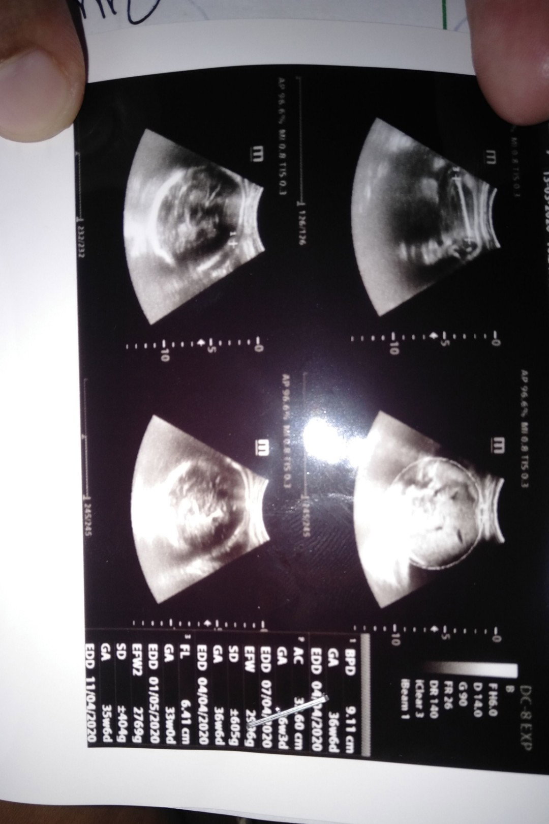 Usia Kandungan Bru 37week Tp D Suruh Sc Gmna Bund?