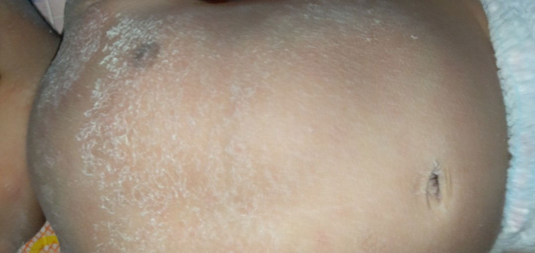 kulit bayi memerah dan bersisik