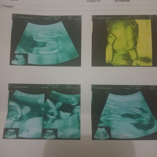 ผลอัลตร้าซาว์