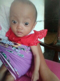 Apa anak sy down syndrome?