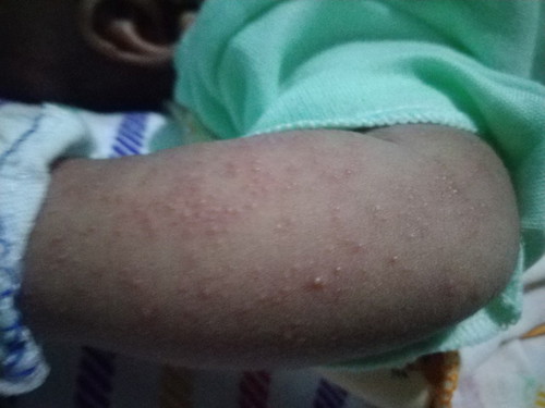 help. biang keringat bayi Newborn