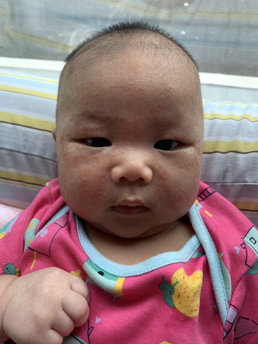 ลูกเป็นผื่นแบบนี้ใช่ยาตัวไหนผื่นถึงจะหายค่ะ