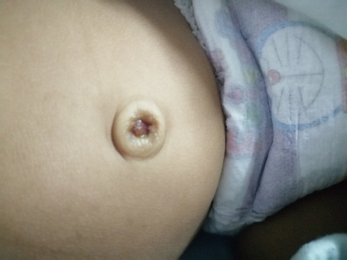 น้อง2เดือนสะดือยังไม่แห้งไปหาหมอ2รอบแล้วยังไม่หายใครเป็นแบบนี้บ้างค่ะ