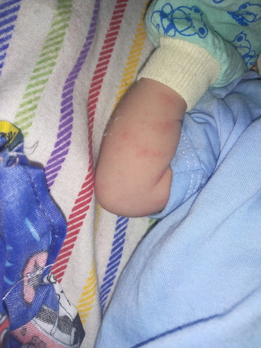 ruam pada kulit bayi