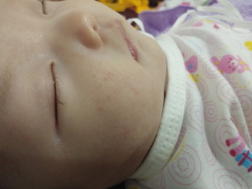 ลูกเป็นผื่นร้อน แม่ๆใช้อะไรทาให้น้องคะ!?