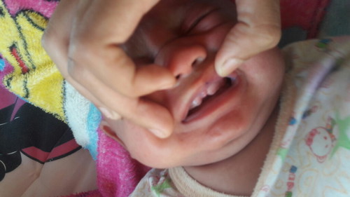 สอบถามแม่ๆเรื่องเหงือก