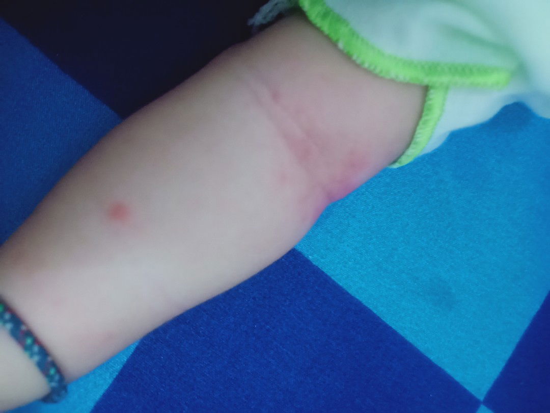 merah2 di sluruh badan