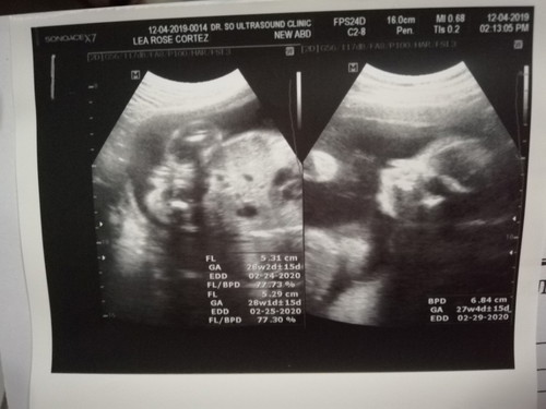 Ultrasound