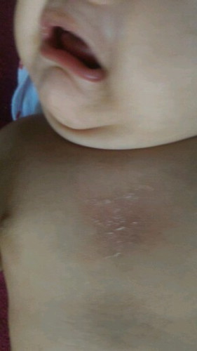 สงสัยเรื่องผิวของลูก