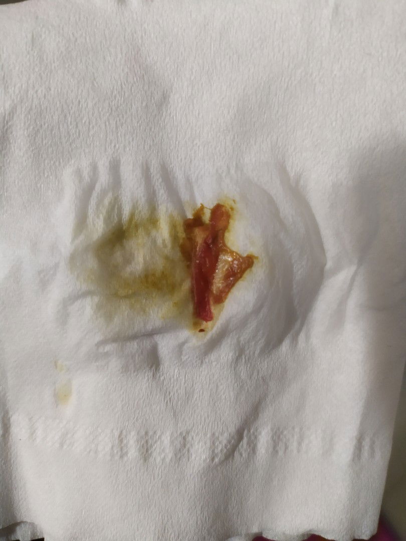 Ketika BAK keluar gumpalan, uk 25w/26w.