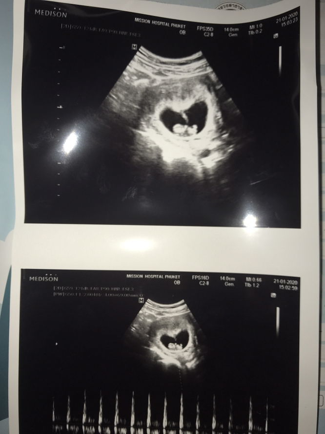 ซาวด์ 8W6D (คุณแม่ เป็นมะเร็งไทรอยด์ แต่รักษา จนหาย แล้ว )