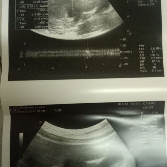 อายุครรภ์ 7 สัปดาห์ซาวด์เห็นหัวใจแต่ไม่ได้ยินเสียง