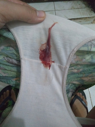 Mucus plug?