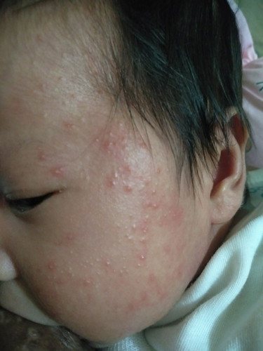 Rashes