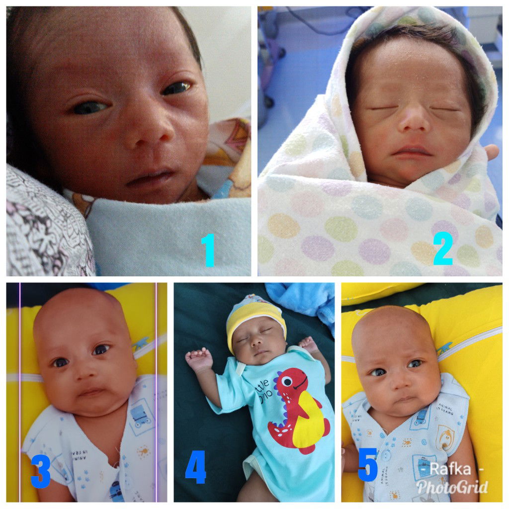 Persalinan di usia kehamilan 34w