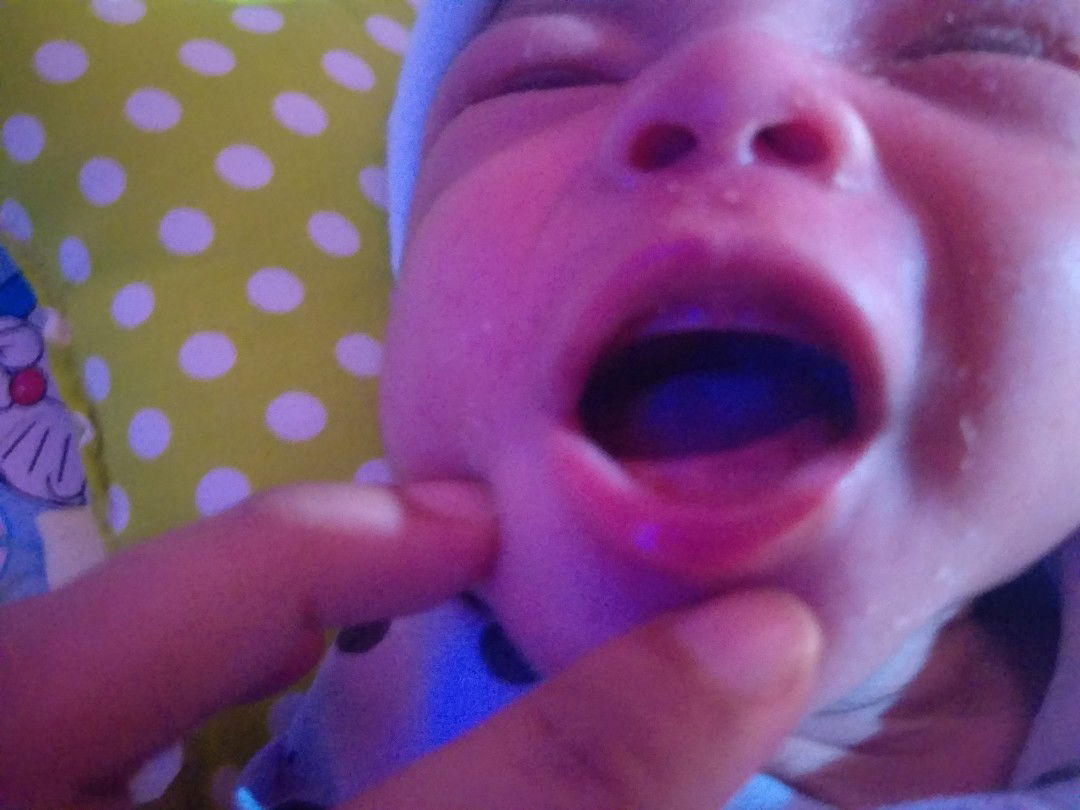 gusi bayi tidak sejajar