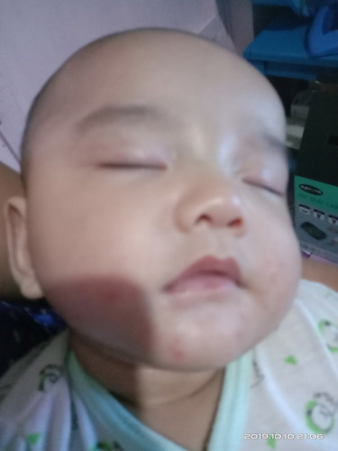 rashes pag dumedede
