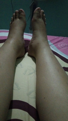 Kaki bengkak