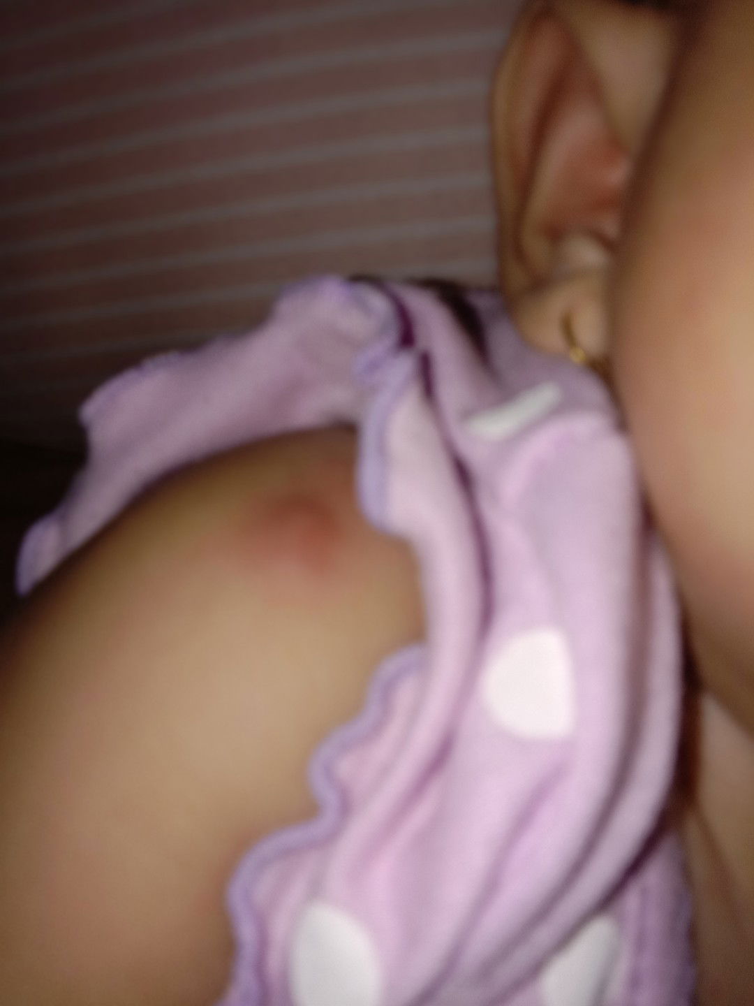 Benjolan apakah ini?