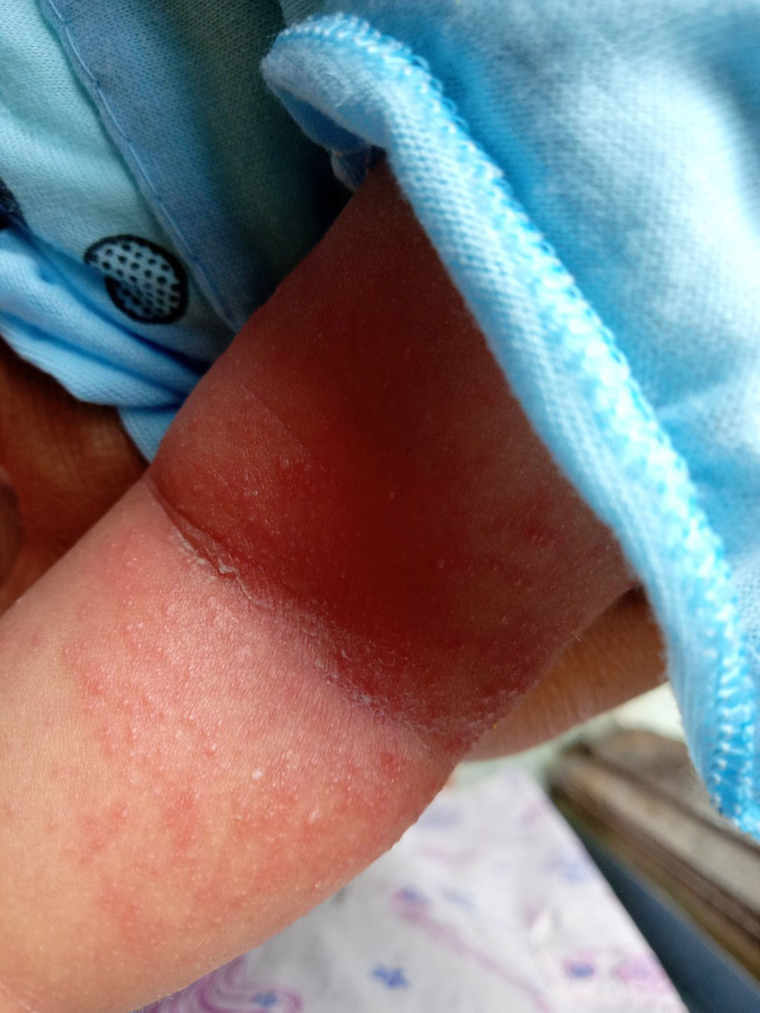 alergi sabun atau biang keringat ??